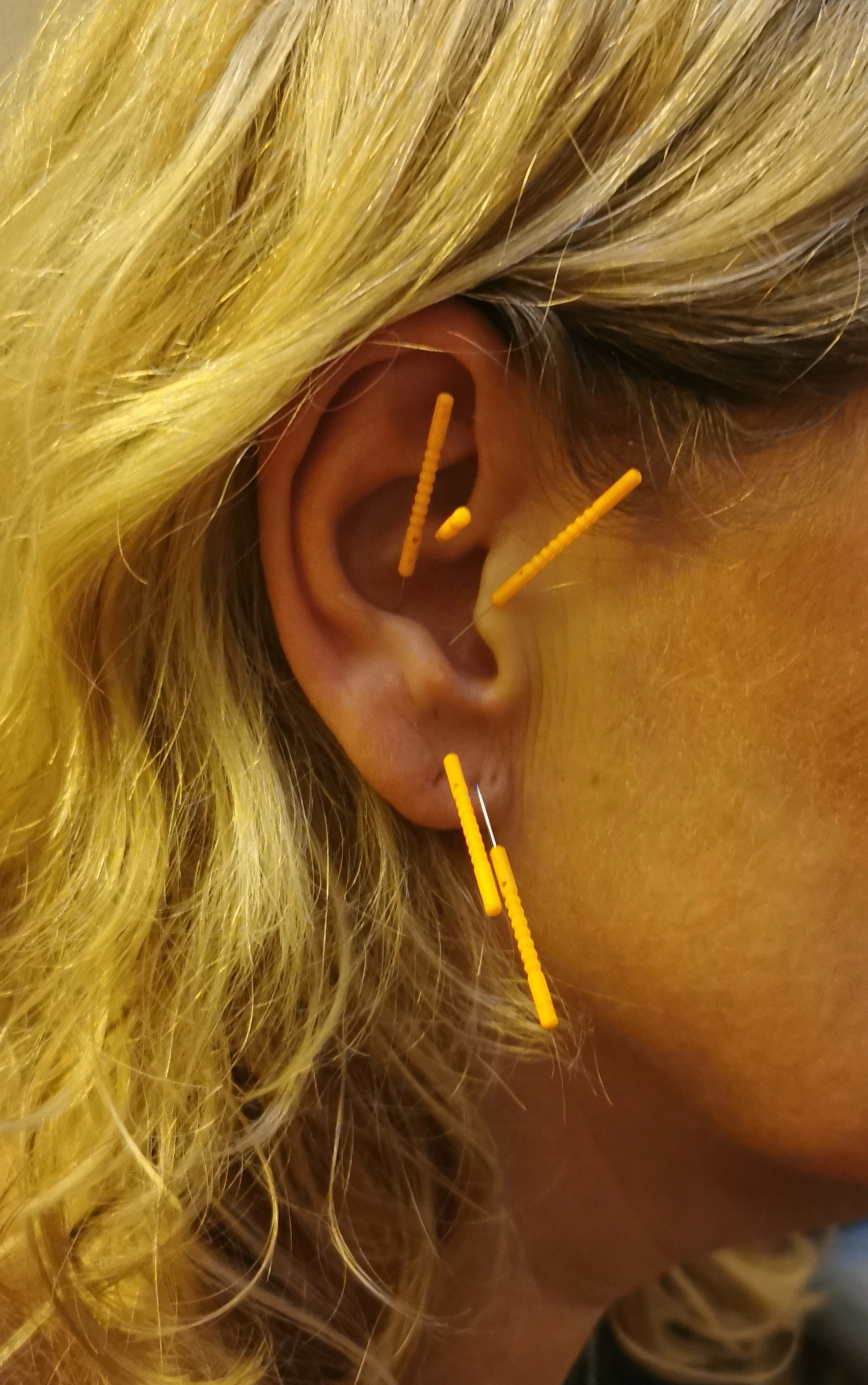 Bild på behandling: Öronakupunktur